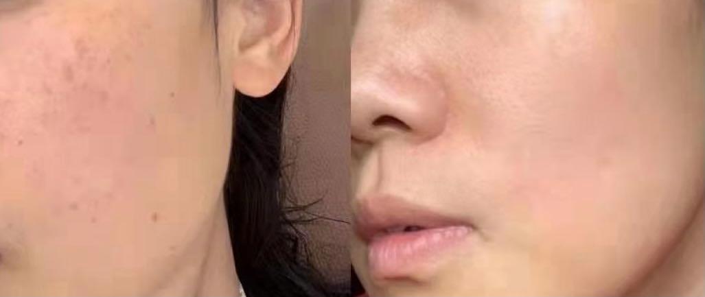 美白祛斑到底能祛斑不反弹吗？这事儿我得跟你唠明白